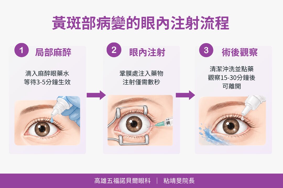 黃斑部病變的眼內注射流程