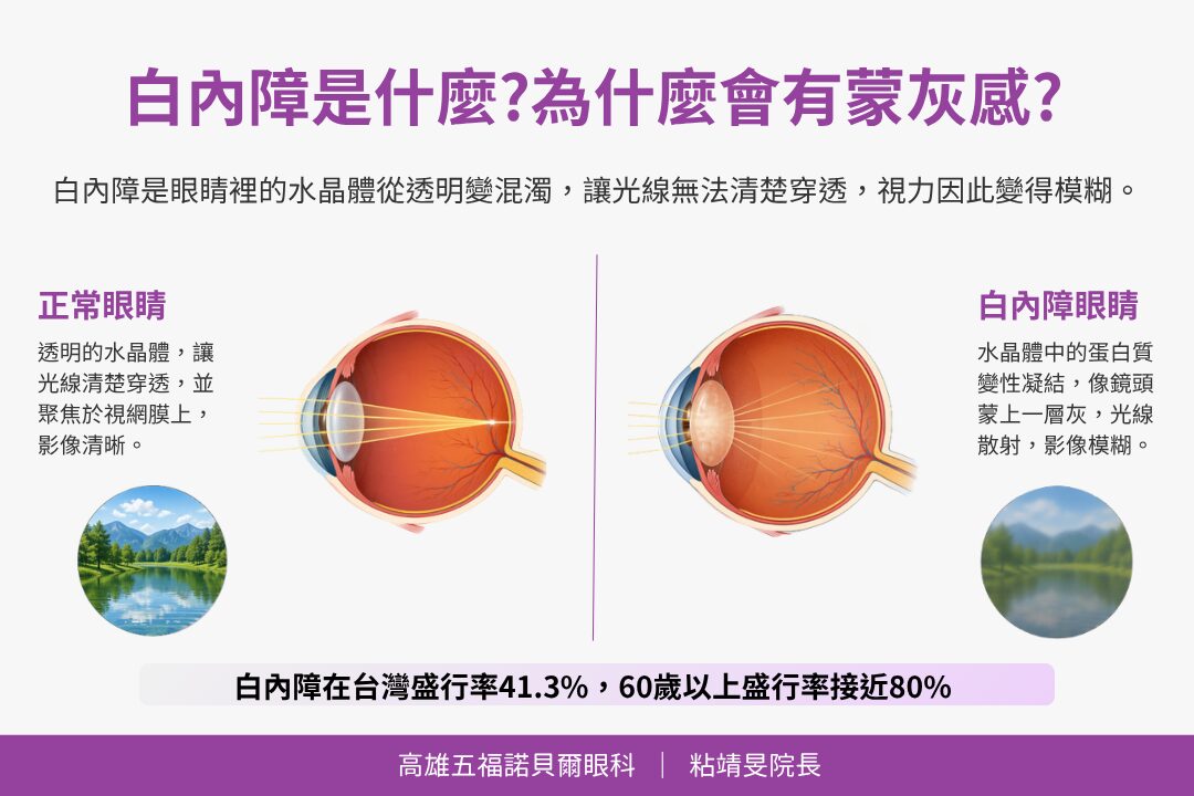 白內障是什麼?為什麼會有蒙灰感?