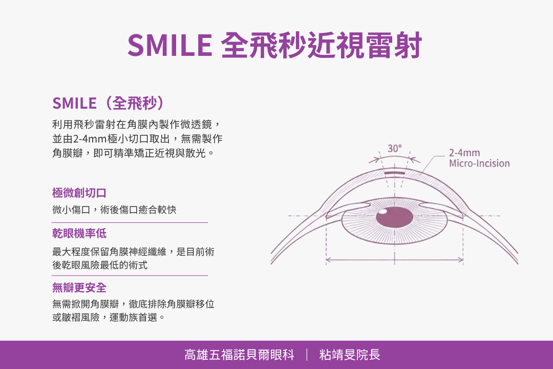 近視雷射 LASIK、SMILE、PRK 有什麼不同?術式原理、品牌、費用完整比較