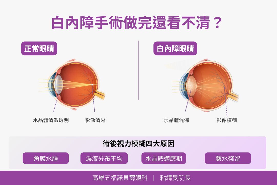 白內障術後視力模糊四大原因